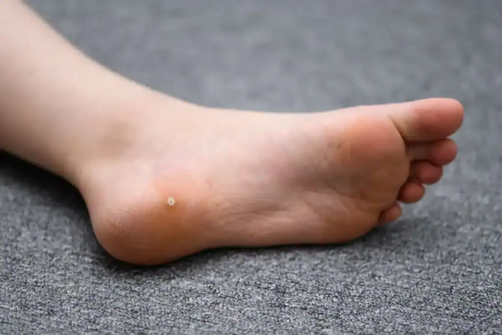 Cryotherapy For Warts And Also Verrucas 2 Image of verruca on the bottom of the foot that able to be treated with Cryotherapy Slough