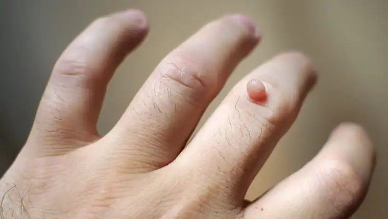 Cryotherapy For Warts And Also Verrucas 1 Image of blemish that Cryotherapy Slough can remove with Lipo 360.